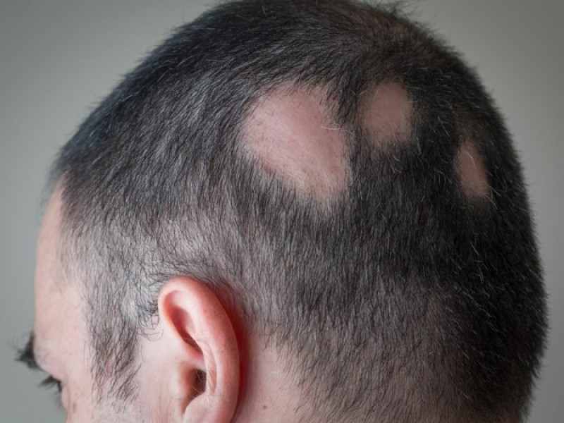 طاسی و کرونای شدید طاسی و کرونای شدید
